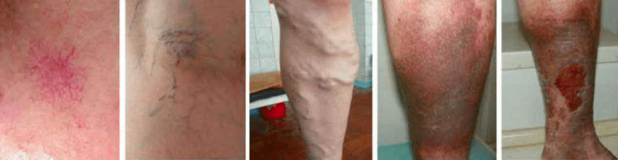 Bacaklardaki varisli damarların aşamaları